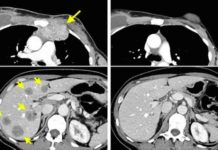 Exito de la inmunoterapia al vencer un cáncer de mama metastásico avanzado