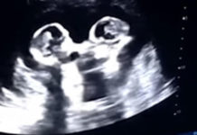 Una ecografía muestra a dos gemelas “peleándose” en el vientre de su madre