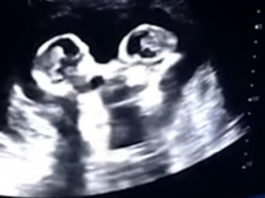 Una ecografía muestra a dos gemelas “peleándose” en el vientre de su madre