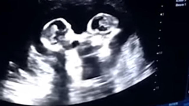 Una ecografía muestra a dos gemelas 